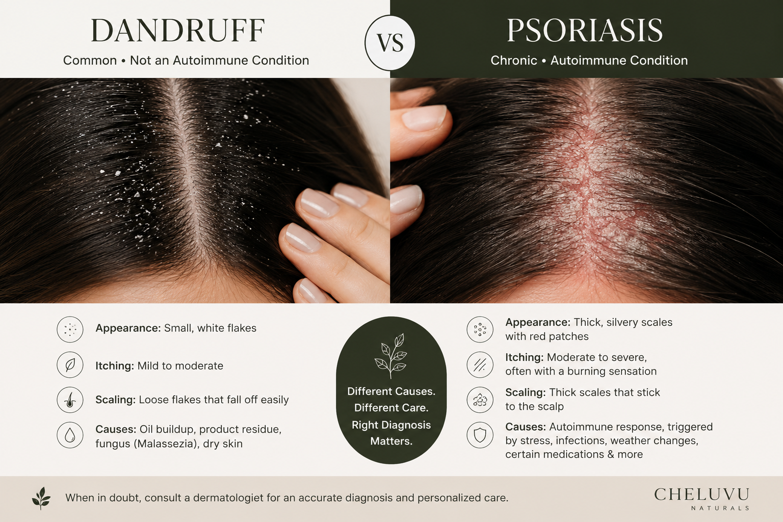 Psoriasis vs Dandruff: Understanding the Difference