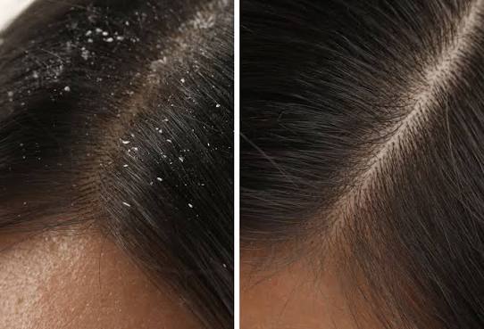 Why Is Your Scalp Itchy Even Without Dandruff? Understanding Scalp Barrier Damage